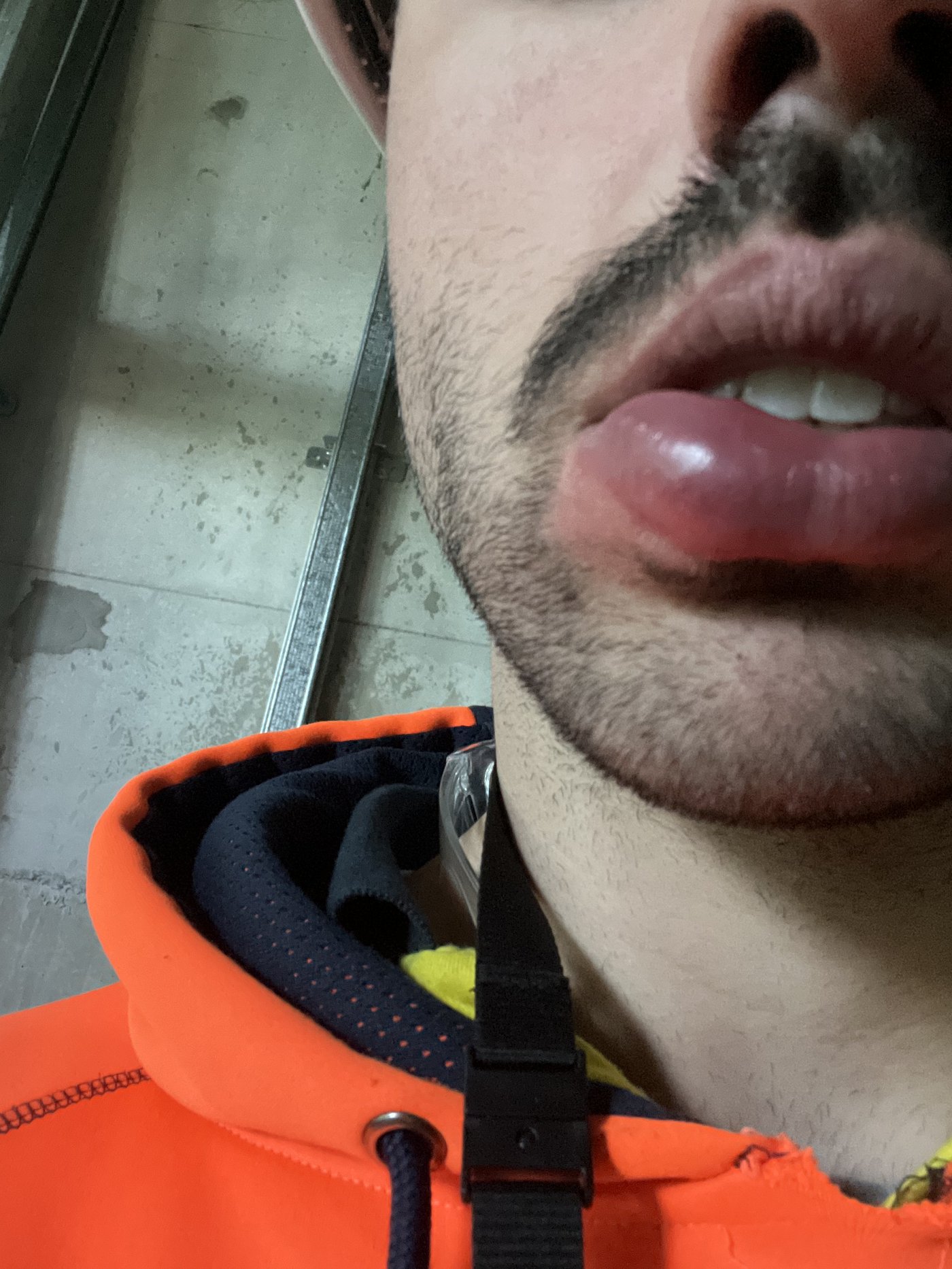 Nathan's health journey - swollen lips from autoimmune reaction