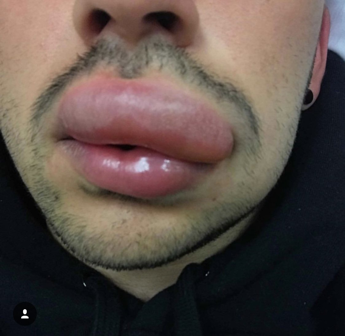 Nathan's health journey - severe autoimmune reaction