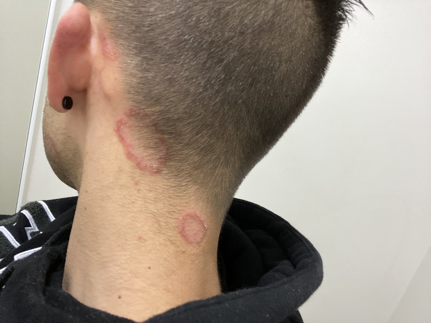 Nathan's health journey - skin lesions from Hashimoto's